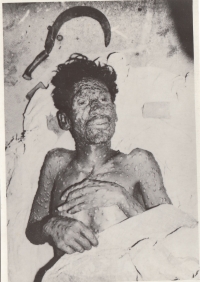 An Indian man afflicted with smallpox. India, 1970's