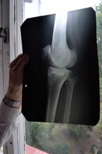 X-ray of his leg gunshot wound 