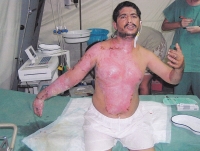 Popálený pacient české polní nemocnice v Iráku, 2003